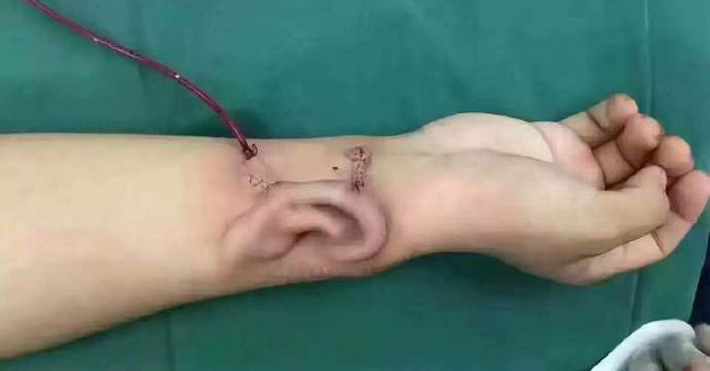 Chinese doctor implants the ear in the patient's hand