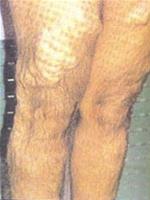 Chronic venous insufficiency: The disease can cause severe disability