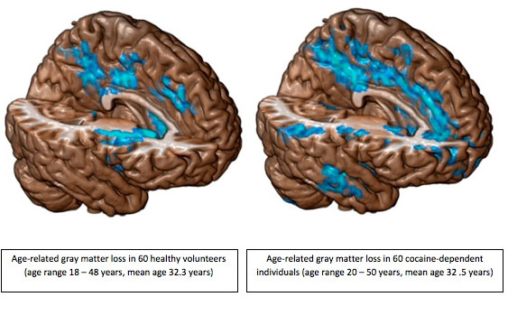 Cocaine wreaks havoc on the brain