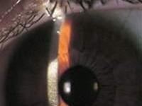 Cogan Syndrome
