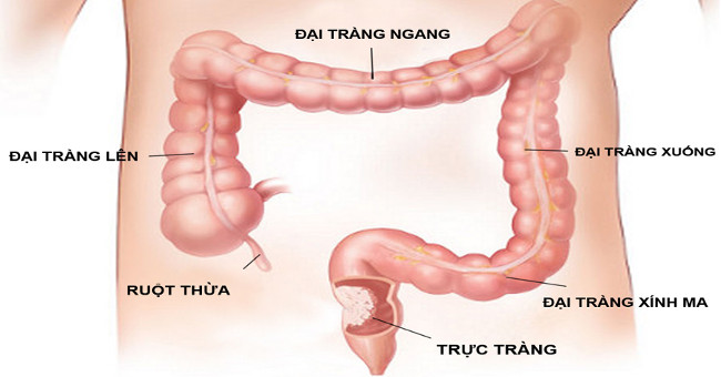 Colorectal cancer: Symptoms, causes and prevention