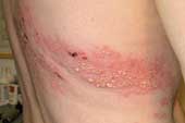 Common mistake in treating shingles (shingles)