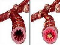 Complications of bronchial asthma