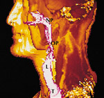 Compounds in fruits are resistant to head and neck cancer