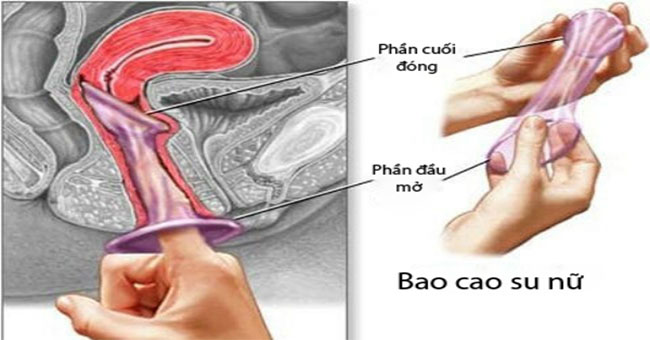 Condoms for women