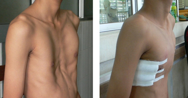Congenital chest concave and health consequences