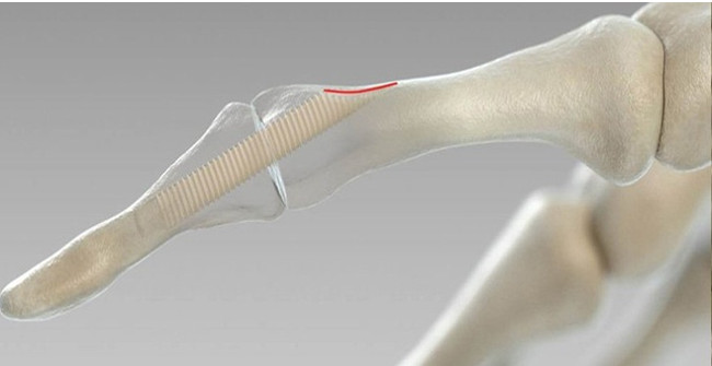 Connect the bones of the screw made from ... human bones