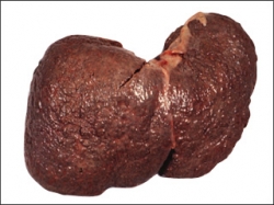 Correctly identify signs of liver cancer