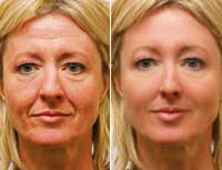 Cosmetic surgery does not use cutlery