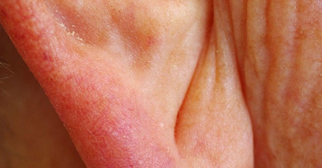 Crossbones in the earlobe warn of cardiovascular disease