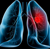 Cuba successfully developed a lung cancer vaccine