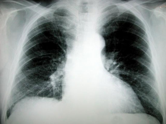 Cuba's forthcoming vaccine can treat lung cancer