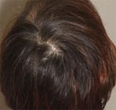 Cure baldness with the patient's own blood