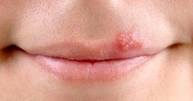 Cure cold sores in the lips