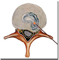 Cure Laser disc herniation