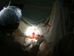 Cut hemorrhoids with high frequency electric burners