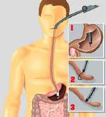 Cut the appendix without surgery