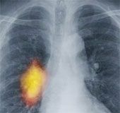 Dangerous cancer - cause and prevention