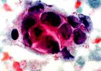 Database of genetic information causing cancer
