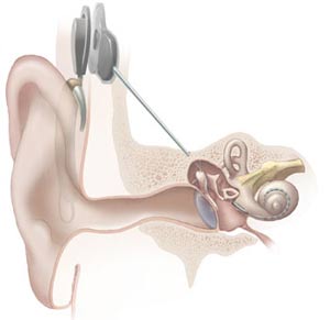 Deafness may increase the risk of childhood meningitis