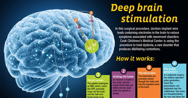 Deep brain stimulation techniques have cured Parkinson's disease, possibly Alzheimer's and depression