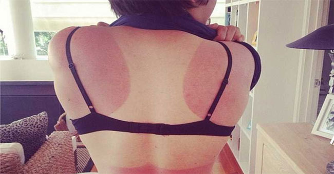 Dermatologists recommend the 3 fastest ways to remove sunburns