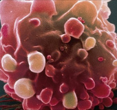 Detected two culprit genes causing bowel cancer