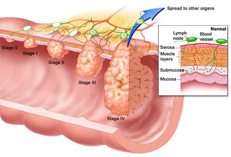 Detecting a mutant gene can prevent cancer from spreading