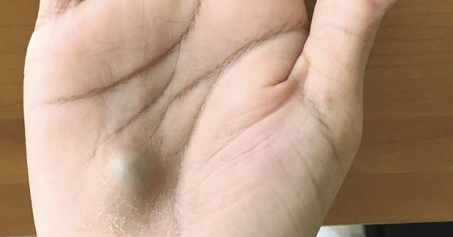 Detecting a strange tumor in the hand, the man almost died of a dangerous disease