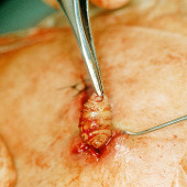 Detecting carnivorous maggots living under human skin