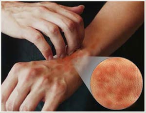 Detecting genes that cause itching