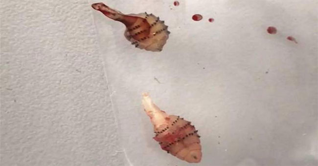 Detecting maggots coming out of the leg after the tour