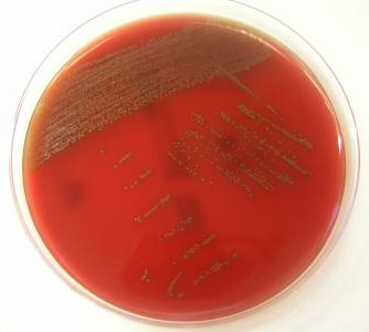 Detecting oral bacteria can cause serious illness