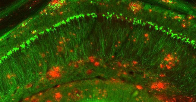 Detecting protein can reverse Alzheimer's symptoms
