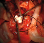 Detecting teeth in newborn brains