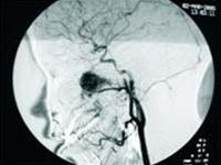 Detection and treatment of nasopharyngeal fibroids