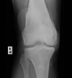 Detection of arthritis by listening to the knee
