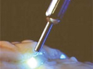 Detection of cancer by Raman laser