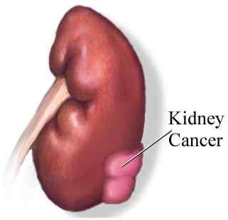 Detection of enzymes for effective treatment of kidney cancer