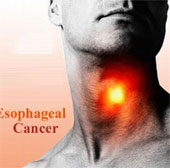 Detection of gene variants causing esophageal cancer