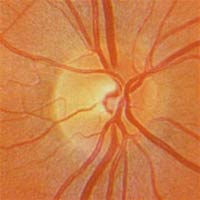 Detection of genes that cause glaucoma