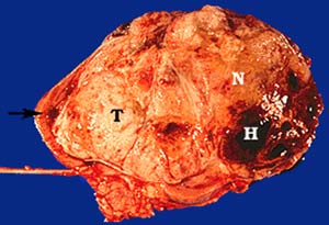 Detection of genes that cause kidney cancer in children