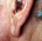 Detection of heart disease by signs of aging