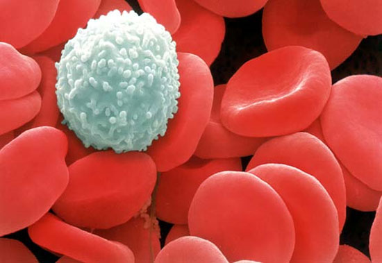 Detection of IVIG is not effective in the treatment of neonatal leukemia