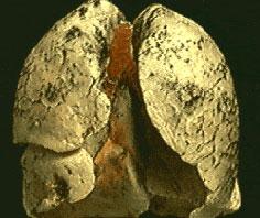 Detection of lung cancer through ... breath