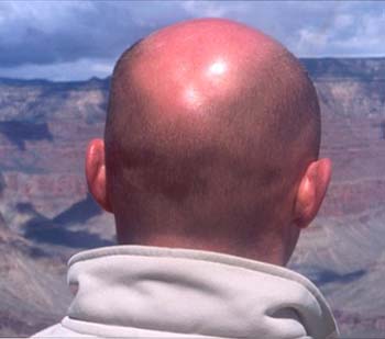 Detection of male pattern baldness