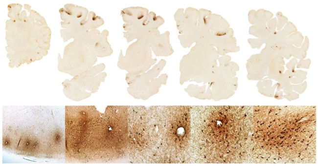 Detection of protein that supports the diagnosis of chronic brain damage disease