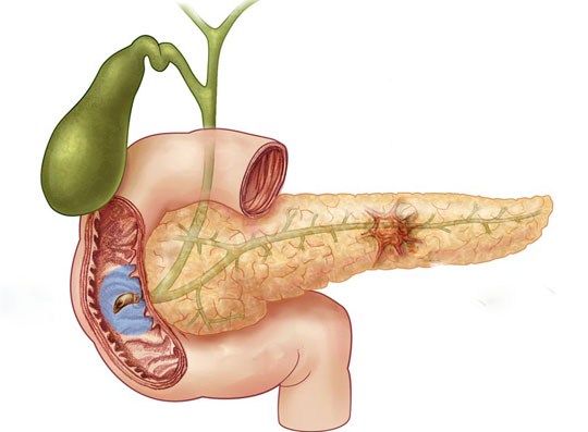 Detection of proteins related to pancreatic cancer