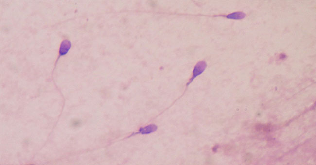 Detection of sperm structure may contribute to infertility