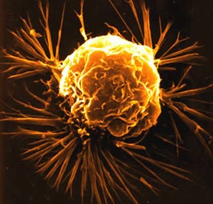 Detection of the gene causes breast cancer to spread to the lungs